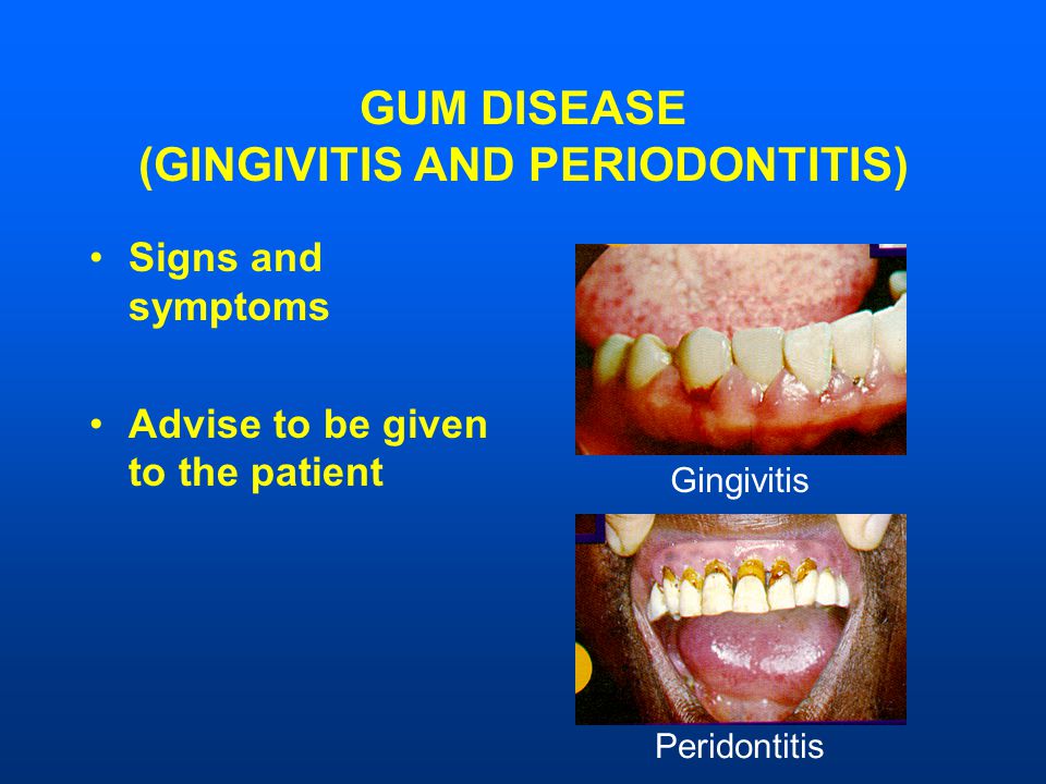GUM DISEASE (GINGIVITIS AND PERIODONTITIS) Signs and symptoms Advise to be given to the patient Gingivitis Peridontitis