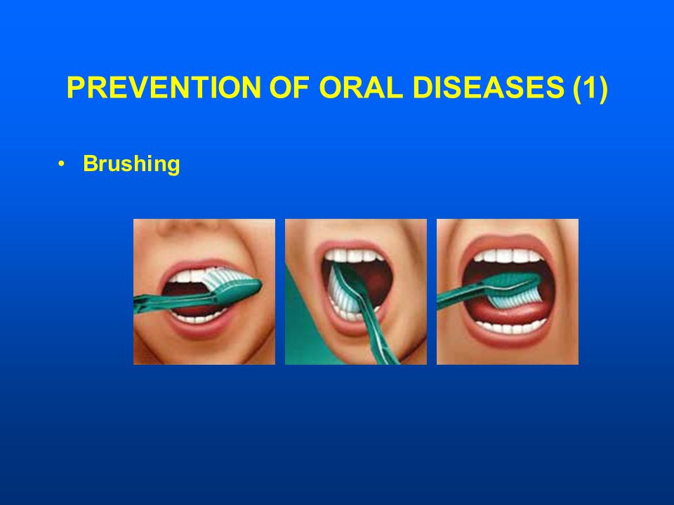 PREVENTION OF ORAL DISEASES (1) Brushing