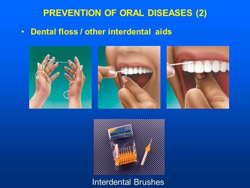 PREVENTION OF ORAL DISEASES (2) Dental floss / other interdental aids Interdental Brushes
