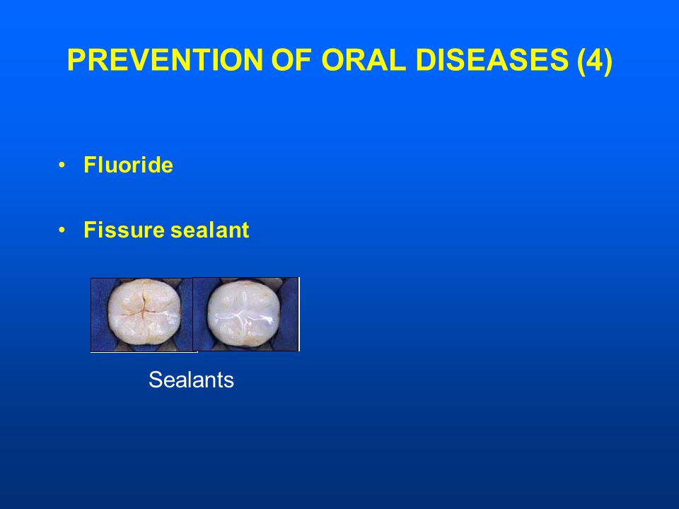 PREVENTION OF ORAL DISEASES (4) Fluoride Fissure sealant Sealants