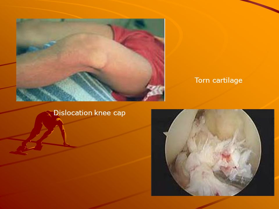 Dislocation knee cap Torn cartilage