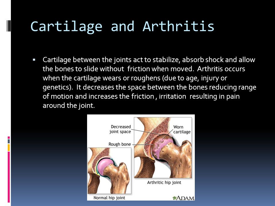 Cartilage and Arthritis  Cartilage between the joints act to stabilize, absorb shock and allow the bones to slide without friction when moved.