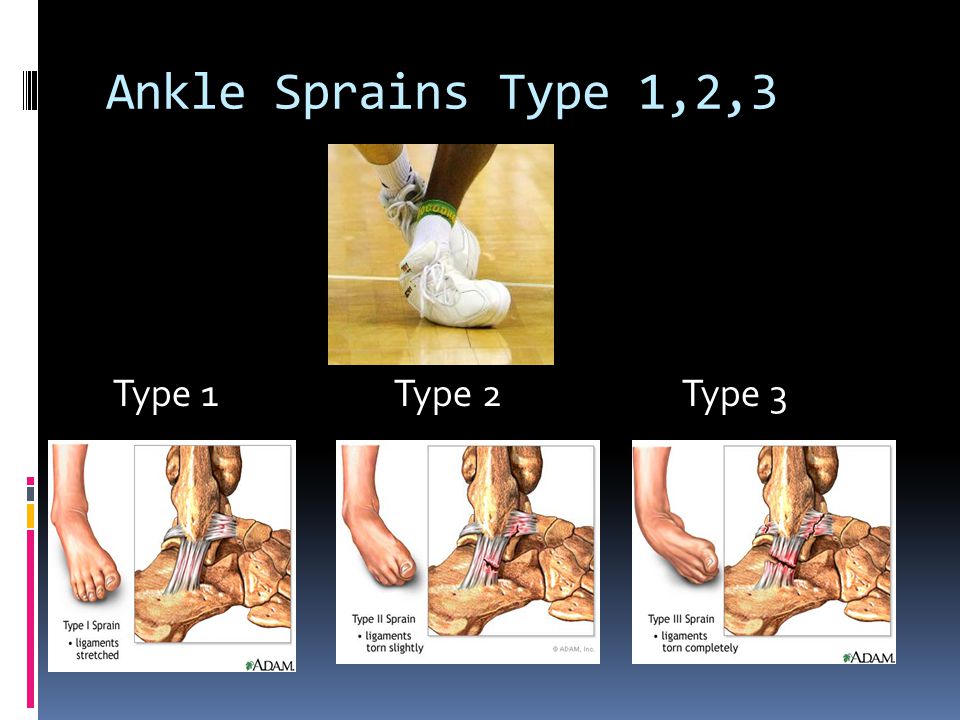Ankle Sprains Type 1,2,3 Type 1Type 2Type 3