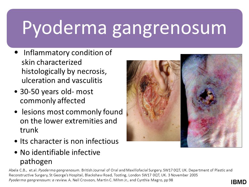ecthyma gangrenosum histology