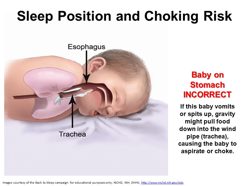 Sleep Position and Choking Risk Images courtesy of the Back to Sleep campaign: for educational purposes only; NICHD, NIH, DHHS;   Baby on Stomach INCORRECT If this baby vomits or spits up, gravity might pull food down into the wind pipe (trachea), causing the baby to aspirate or choke.