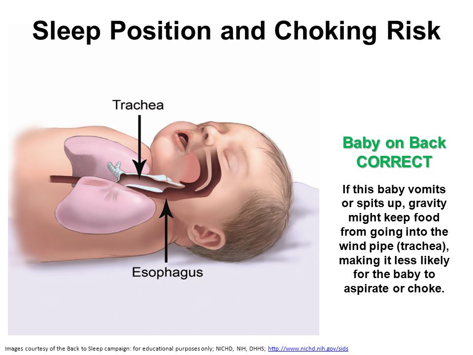 Sleep Position and Choking Risk Images courtesy of the Back to Sleep campaign: for educational purposes only; NICHD, NIH, DHHS;   Baby on Back CORRECT If this baby vomits or spits up, gravity might keep food from going into the wind pipe (trachea), making it less likely for the baby to aspirate or choke.