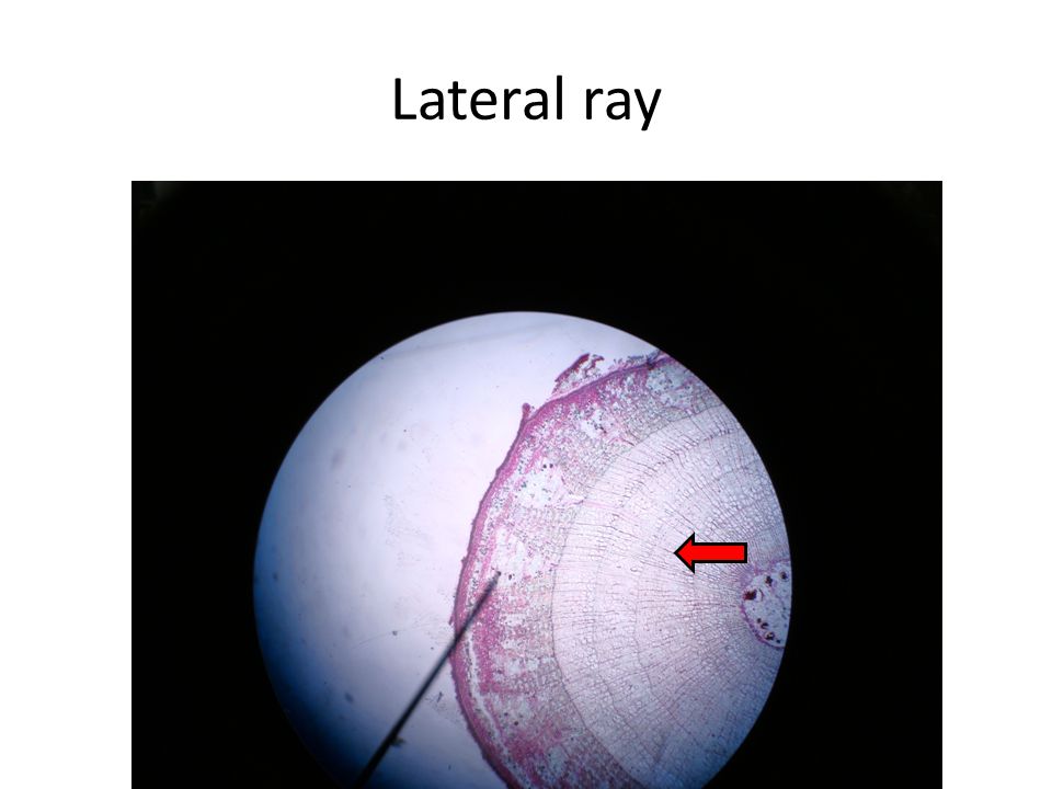 Lateral ray
