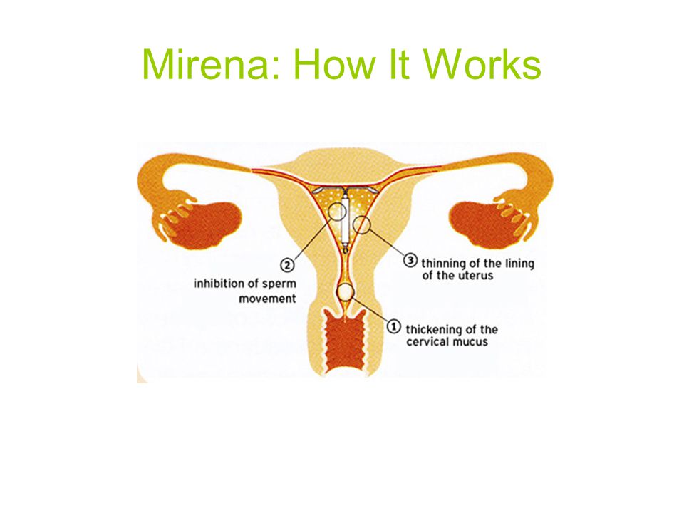 Mirena: How It Works