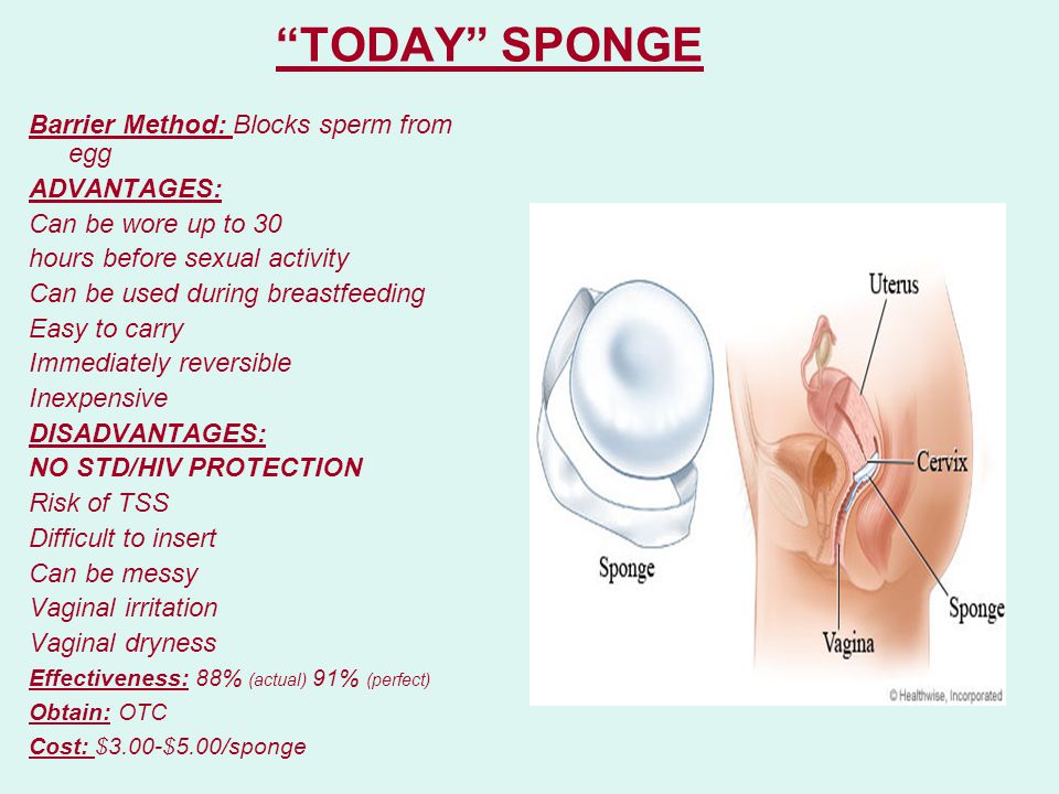 Retained vaginal sponge
