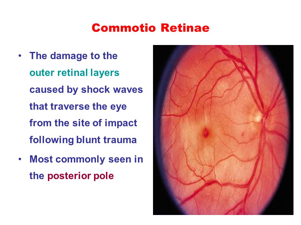 12 Commotio Retinae The Damage To Outer Retinal Layers Caused By Shock Waves That Traverse Eye From Site Of Impact Following Blunt Trauma Most 12 Commotio Retinae The Damage To Outer Retinal Layers Caused By Shock Waves That Traverse Eye From Site Of Impact Following Blunt Trauma Most