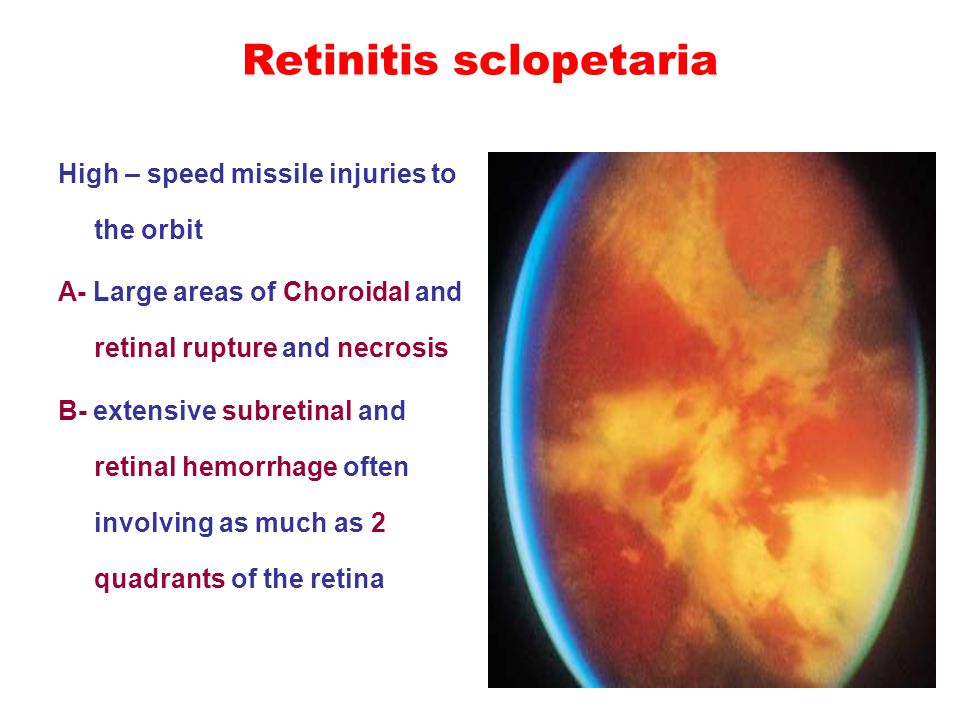 Posterior Segment Trauma DrAli Salehi BLUNT TRAUMA Ocular Is Posterior Segment Trauma DrAli Salehi BLUNT TRAUMA Ocular Is