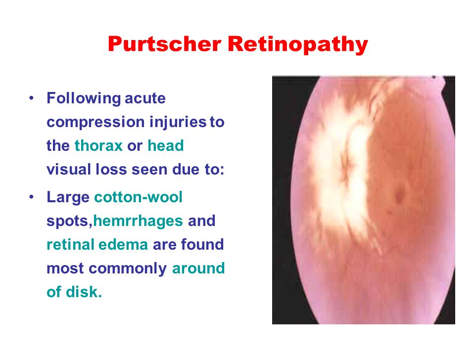 44 Purtscher Retinopathy Following Acute Compression Injuries To The Thorax Or Head Visual Loss Seen Due Large Cotton Wool Spotshemrrhages And Retinal 44 Purtscher Retinopathy Following Acute Compression Injuries To The Thorax Or Head Visual Loss Seen Due Large Cotton Wool Spotshemrrhages And Retinal