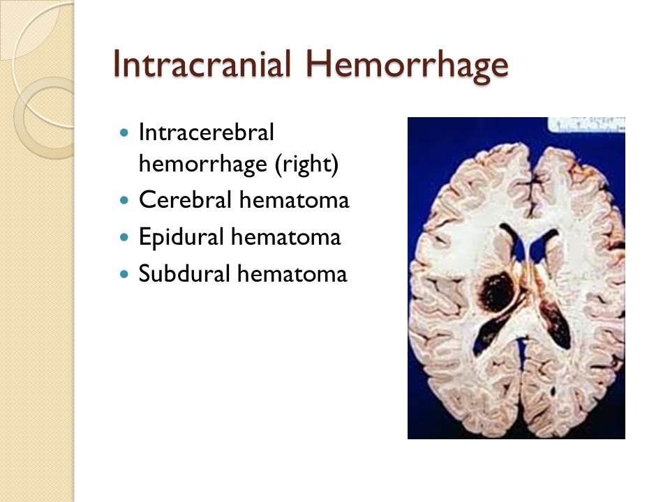 Intracranial Hemorrhage Intracerebral hemorrhage (right) Cerebral hematoma Epidural hematoma Subdural hematoma