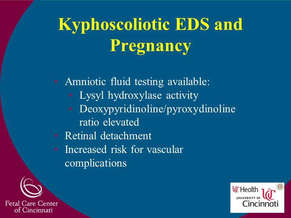 Kyphoscoliotic EDS and Pregnancy Amniotic fluid testing available: Lysyl hydroxylase activity Deoxypyridinoline/pyroxydinoline ratio elevated Retinal detachment Increased risk for vascular complications