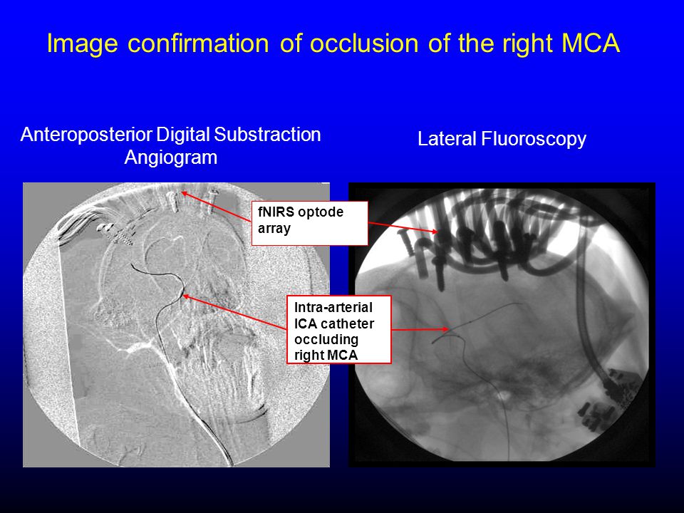 Anteroposterior Digital Substraction Angiogram Image confirmation of occlusion of the right MCA Intra-arterial ICA catheter occluding right MCA fNIRS optode array Lateral Fluoroscopy
