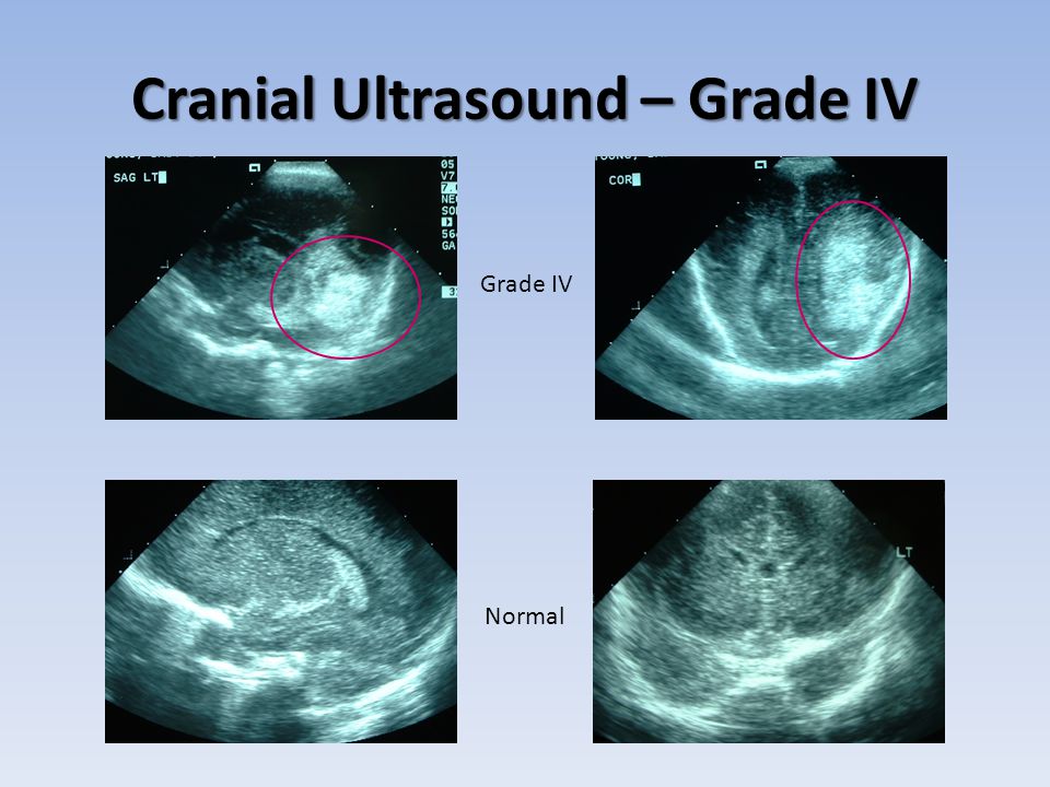 Cranial Ultrasound – Grade IV Normal Grade IV