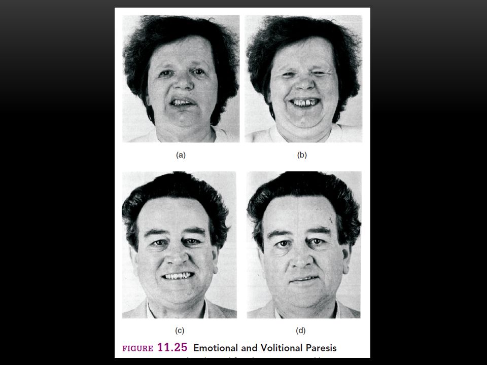 volitional facial paresis Volitional facial paresis