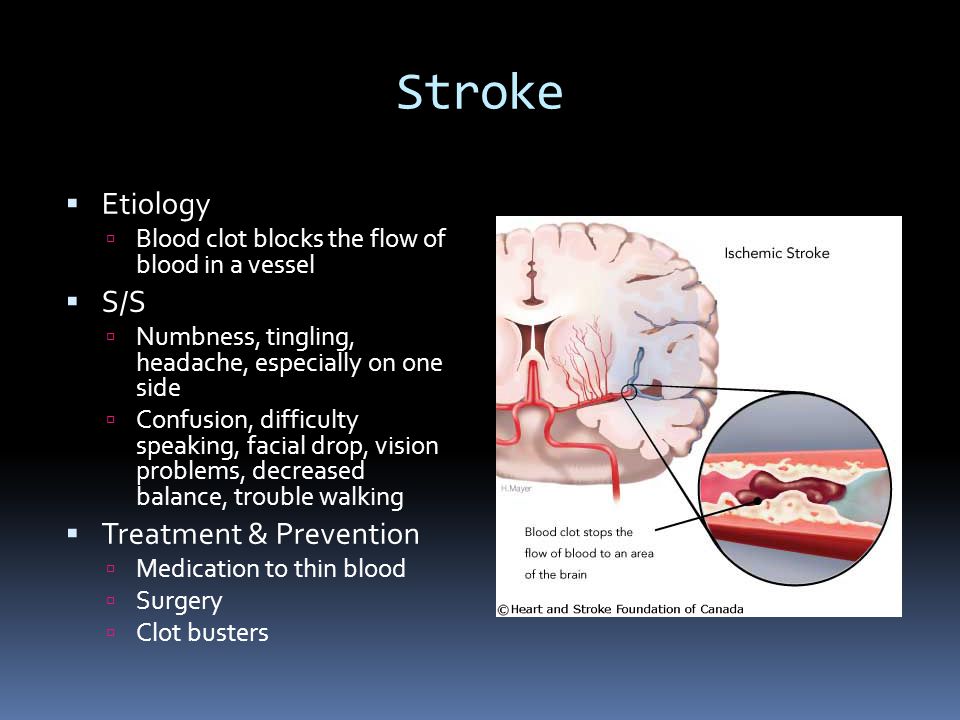 Stroke  Etiology  Blood clot blocks the flow of blood in a vessel  S/S  Numbness, tingling, headache, especially on one side  Confusion, difficulty speaking, facial drop, vision problems, decreased balance, trouble walking  Treatment & Prevention  Medication to thin blood  Surgery  Clot busters