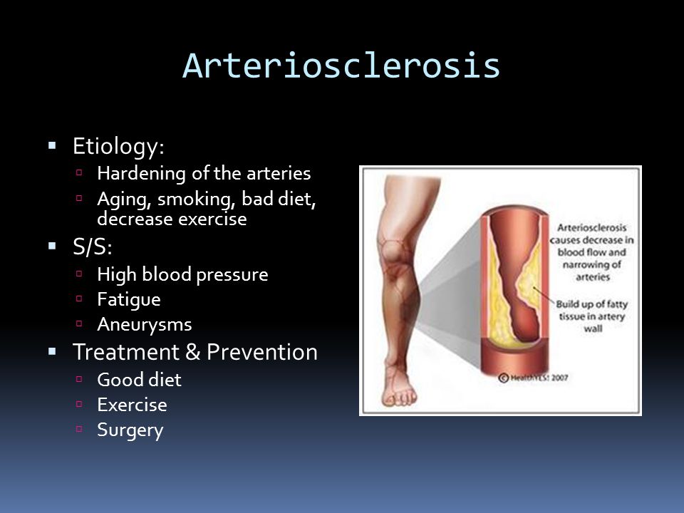 Arteriosclerosis  Etiology:  Hardening of the arteries  Aging, smoking, bad diet, decrease exercise  S/S:  High blood pressure  Fatigue  Aneurysms  Treatment & Prevention  Good diet  Exercise  Surgery