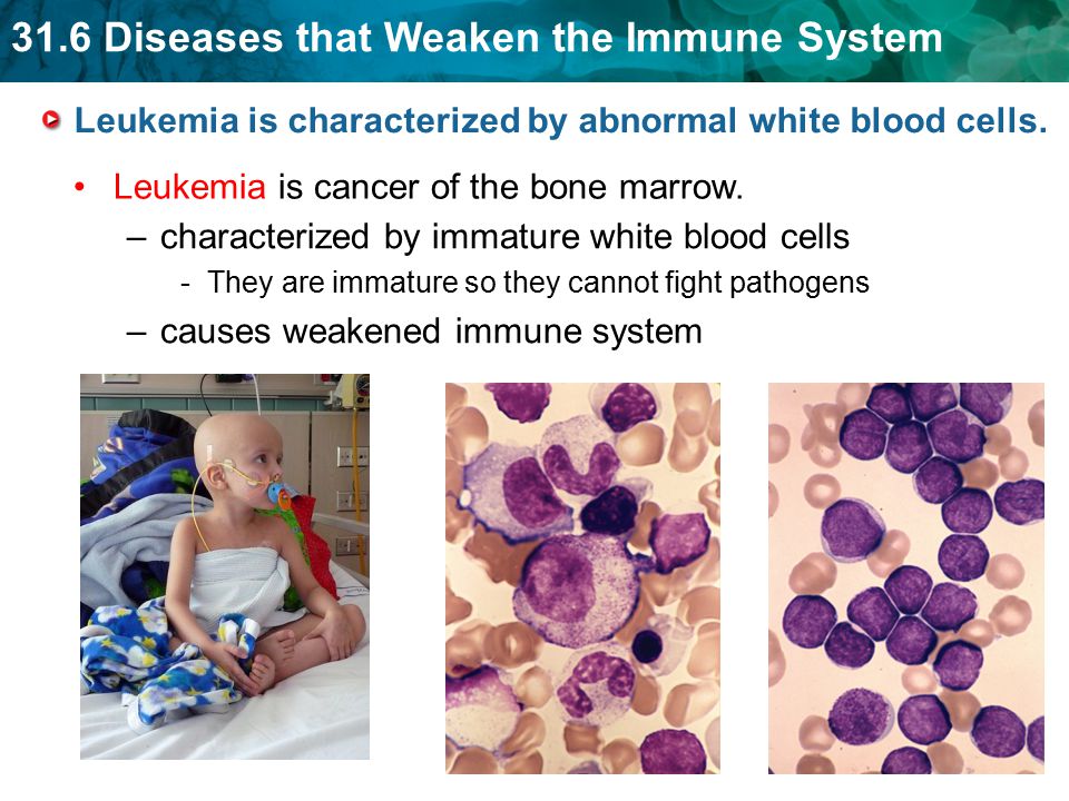 31.6 Diseases that Weaken the Immune System Leukemia is characterized by abnormal white blood cells.