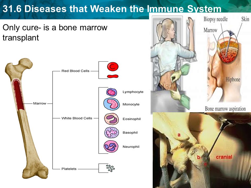 31.6 Diseases that Weaken the Immune System Only cure- is a bone marrow transplant