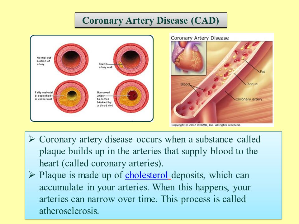 Coronary Artery Disease (CAD)  Coronary artery disease occurs when a substance called plaque builds up in the arteries that supply blood to the heart (called coronary arteries).