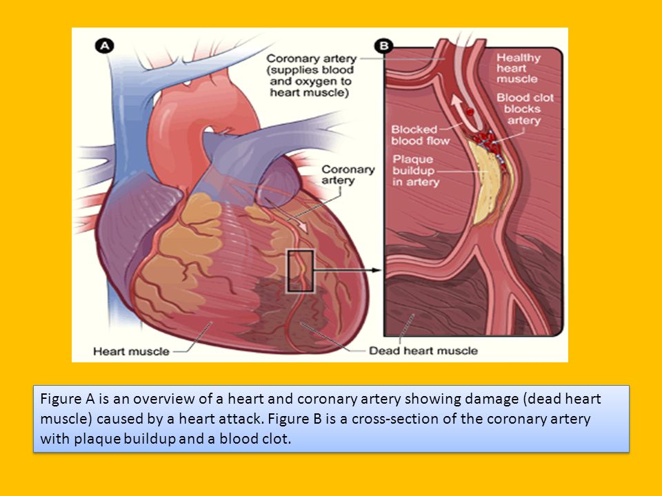 Figure A is an overview of a heart and coronary artery showing damage (dead heart muscle) caused by a heart attack.