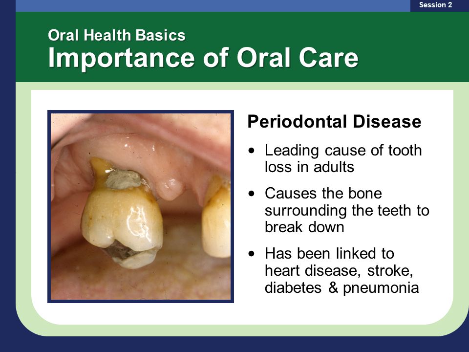 Oral Health Basics Importance of Oral Care Periodontal Disease Leading cause of tooth loss in adults Causes the bone surrounding the teeth to break down Has been linked to heart disease, stroke, diabetes & pneumonia Session 2