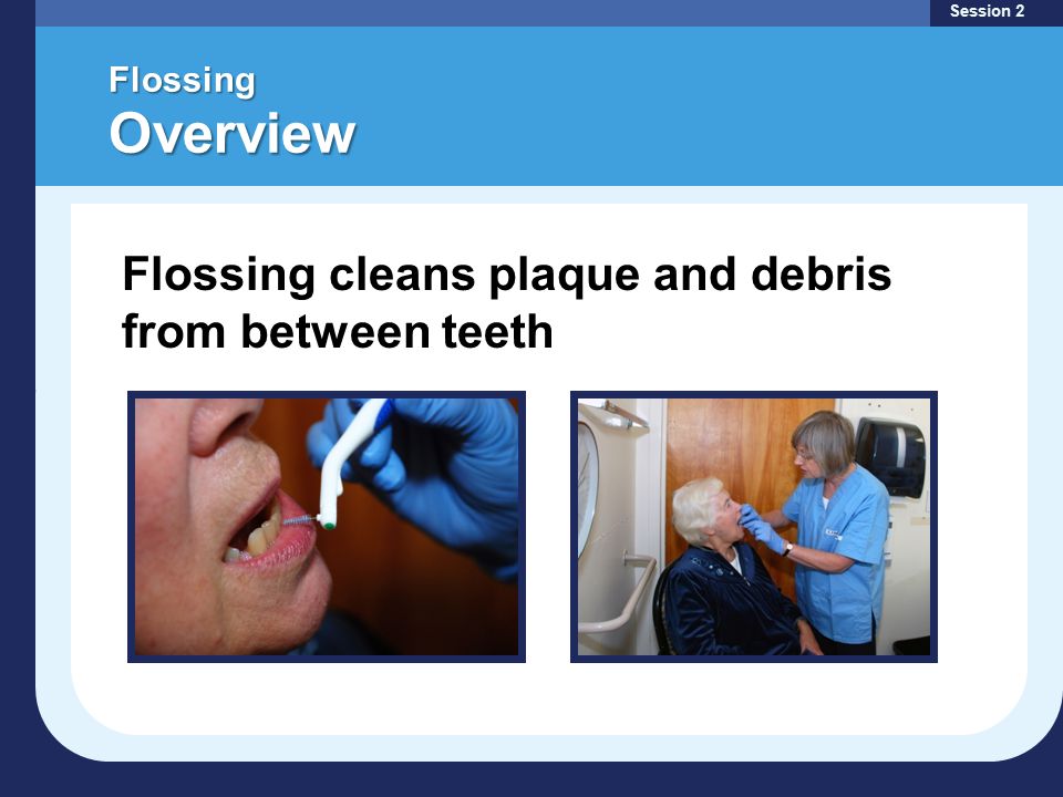 Flossing Overview Session 2 Flossing cleans plaque and debris from between teeth