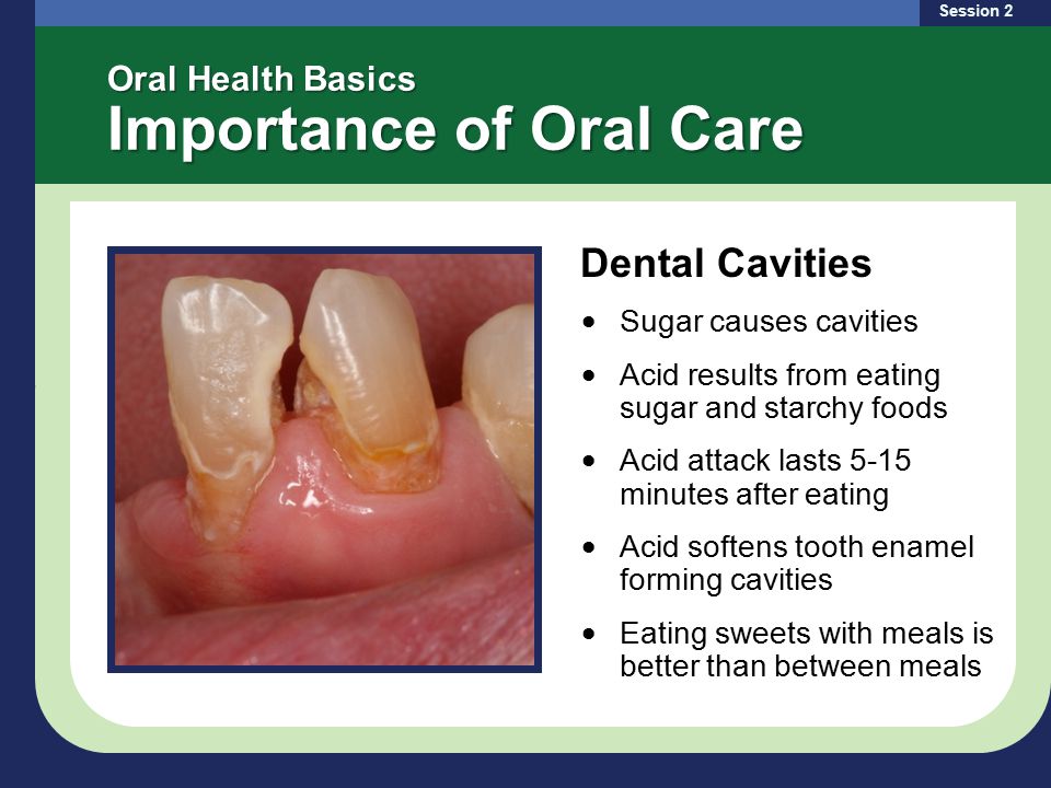 Oral Health Basics Importance of Oral Care Session 2 Dental Cavities Sugar causes cavities Acid results from eating sugar and starchy foods Acid attack lasts 5-15 minutes after eating Acid softens tooth enamel forming cavities Eating sweets with meals is better than between meals