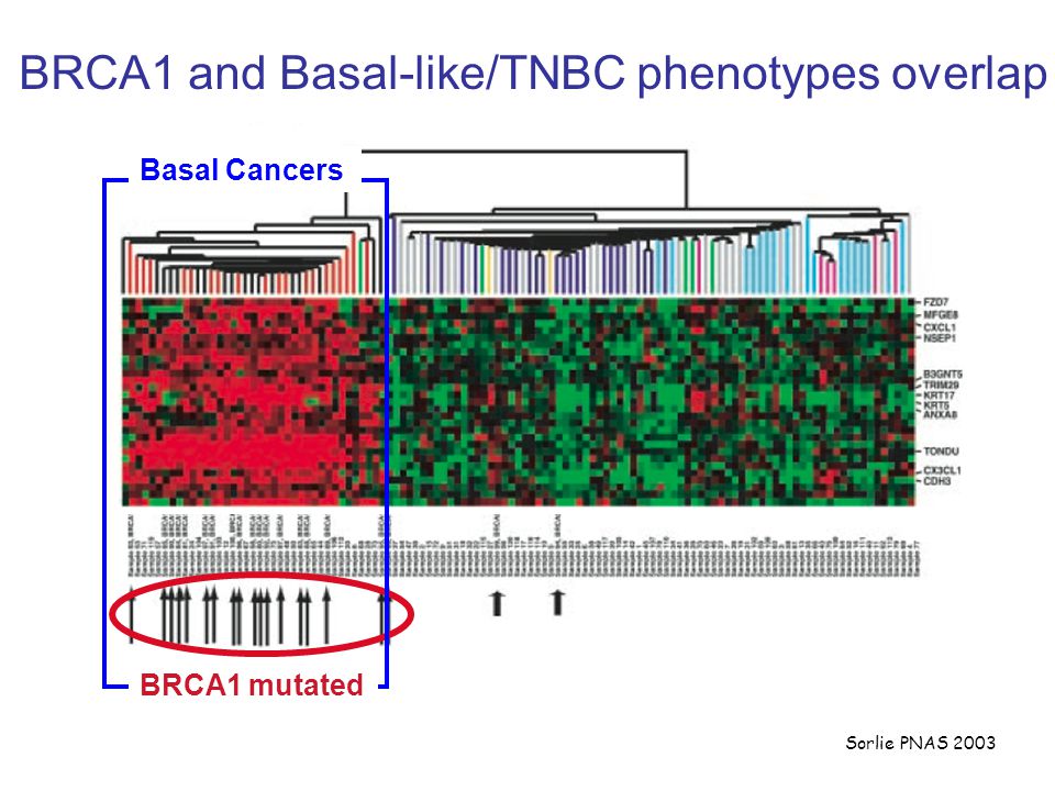 Sorlie PNAS 2003 BRCA1 and Basal-like/TNBC phenotypes overlap Basal-like Sub-Type BRCA1 mutated Basal Cancers