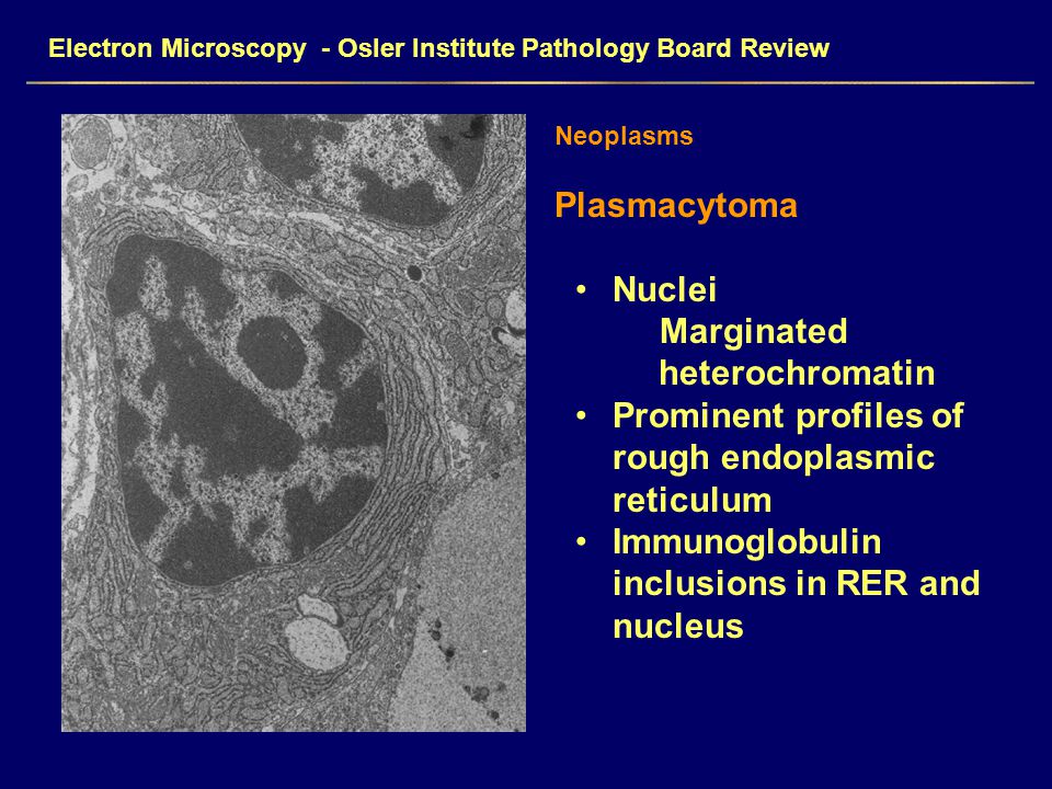 Electron Microscopy - Osler Institute Pathology Board Review Neoplasms Plasmacytoma Nuclei Marginated heterochromatin Prominent profiles of rough endoplasmic reticulum Immunoglobulin inclusions in RER and nucleus