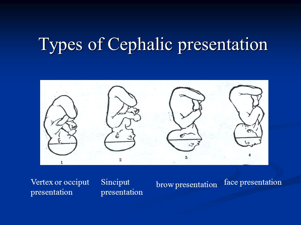 Types of Cephalic presentation Types of Cephalic presentation Vertex or occiput presentation Sinciput presentation brow presentation face presentation