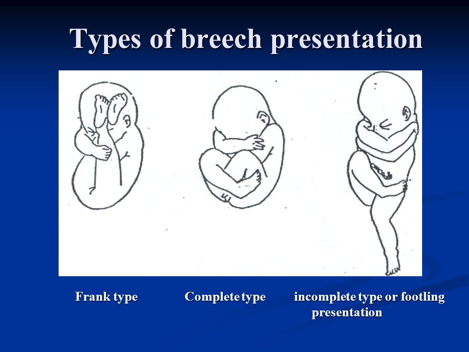 Types of breech presentation Frank type Complete type incomplete type or footling presentation