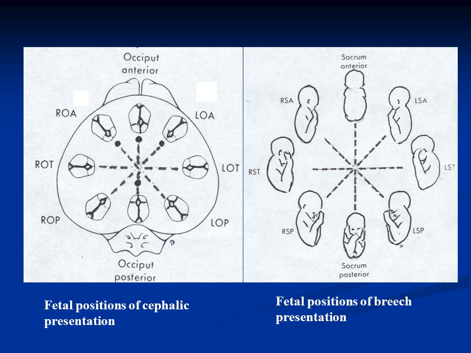 Fetal positions of cephalic presentation Fetal positions of breech presentation