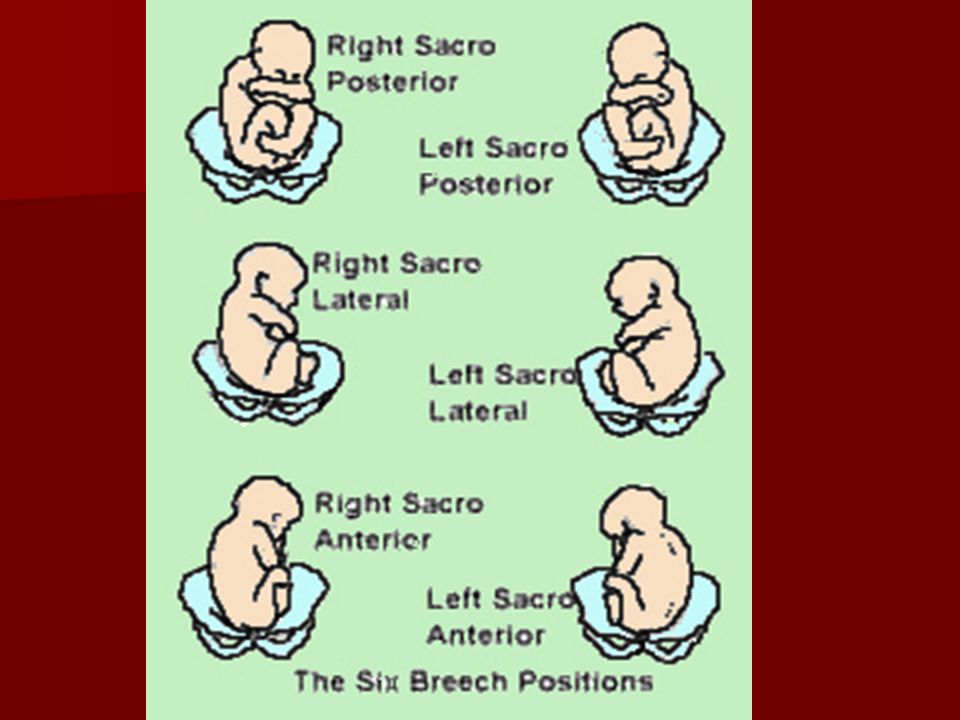 Malpresentation And Cord Prolapse Ppt Video Online Download