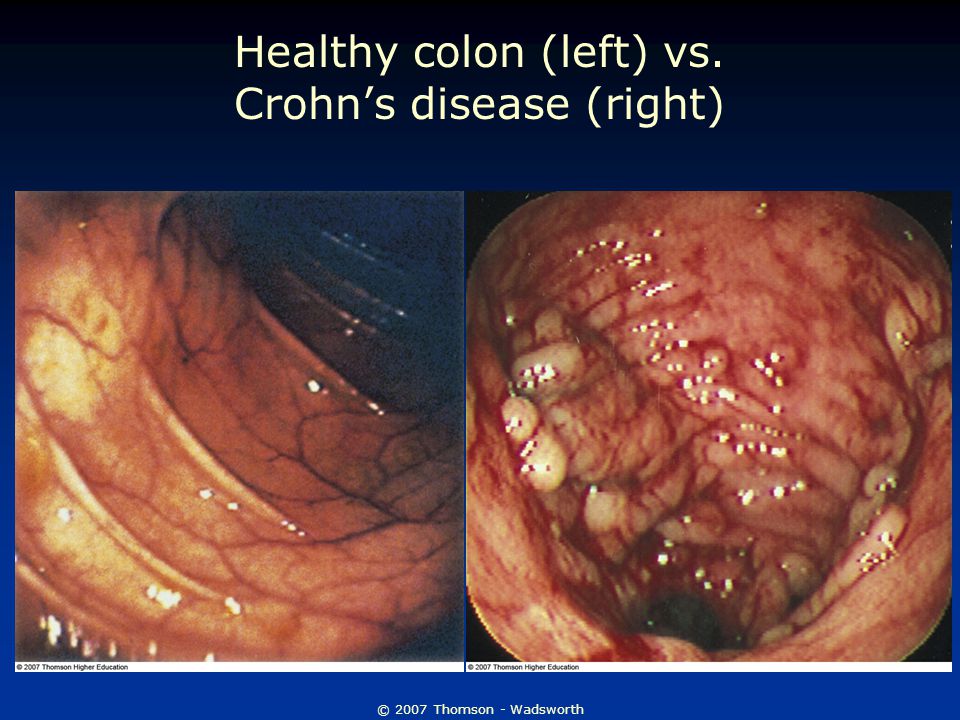 © 2007 Thomson - Wadsworth Healthy colon (left) vs. Crohn’s disease (right)