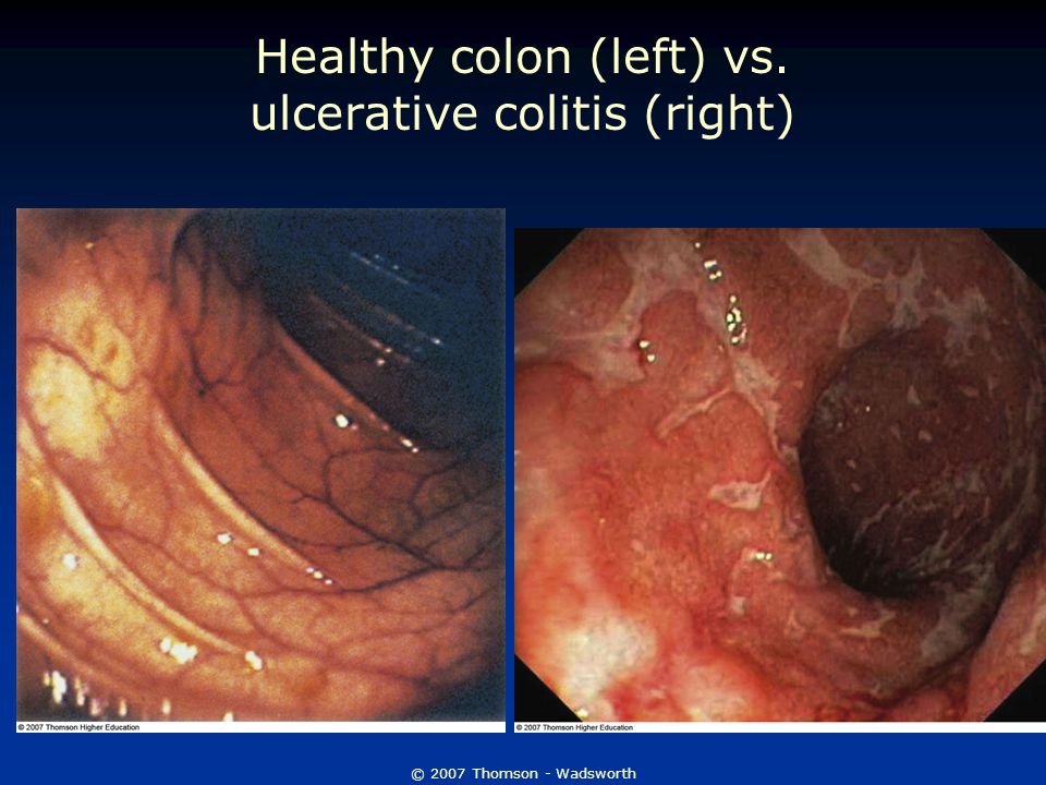 © 2007 Thomson - Wadsworth Healthy colon (left) vs. ulcerative colitis (right)