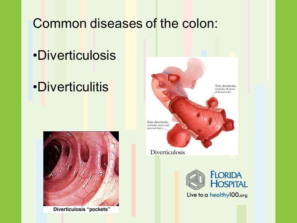 Common diseases of the colon: Diverticulosis Diverticulitis