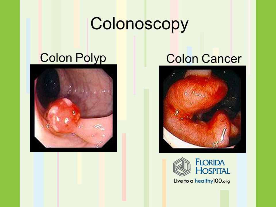 Colonoscopy Colon Polyp Colon Cancer