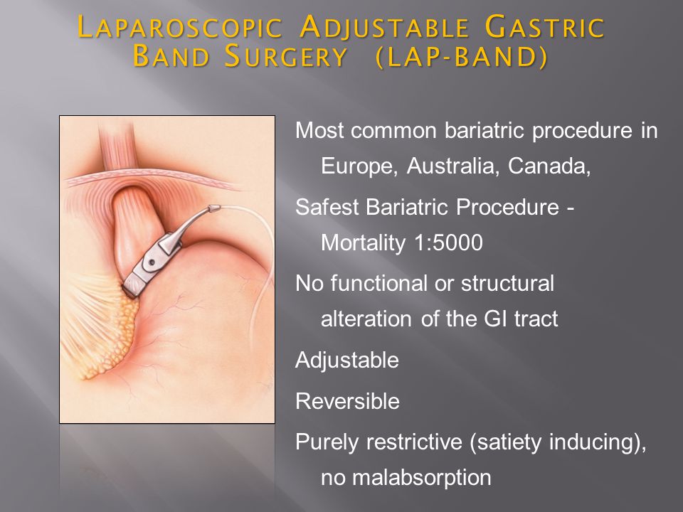 L APAROSCOPIC A DJUSTABLE G ASTRIC B AND S URGERY (LAP-BAND) Most common bariatric procedure in Europe, Australia, Canada, Safest Bariatric Procedure - Mortality 1:5000 No functional or structural alteration of the GI tract Adjustable Reversible Purely restrictive (satiety inducing), no malabsorption