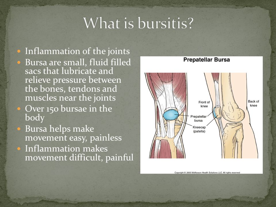 Inflammation of the joints Bursa are small, fluid filled sacs that lubricate and relieve pressure between the bones, tendons and muscles near the joints Over 15o bursae in the body Bursa helps make movement easy, painless Inflammation makes movement difficult, painful