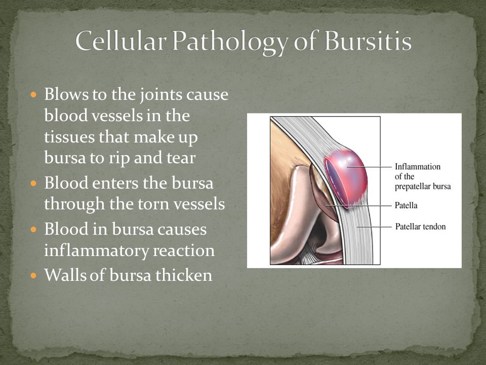 Blows to the joints cause blood vessels in the tissues that make up bursa to rip and tear Blood enters the bursa through the torn vessels Blood in bursa causes inflammatory reaction Walls of bursa thicken