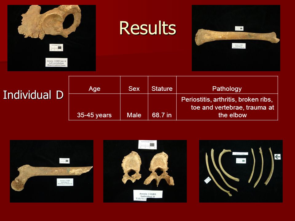 Results Individual D AgeSexStaturePathology yearsMale68.7 in Periostitis, arthritis, broken ribs, toe and vertebrae, trauma at the elbow