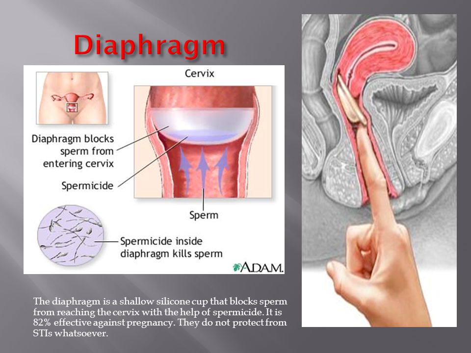 Diaphragm Birth Control Method