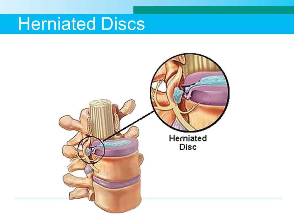 Herniated Discs