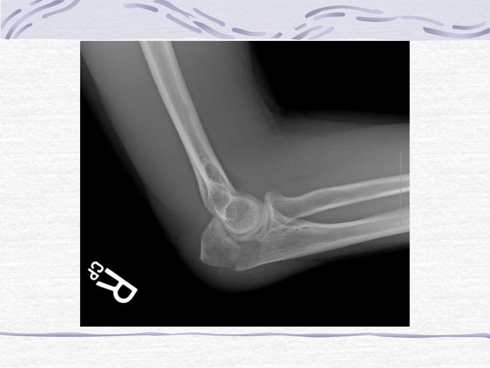 Трещина в суставе. Локтевой сустав рентген норма. Рентгенограмма локтевого сустава. Левый локтевой сустав рентген. Рентген снимок локтевого сустава.