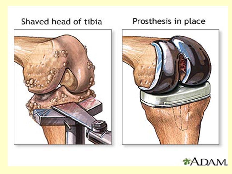Форум операции по замене суставов. Артроз коленного сустава эндопротез. Схема операции эндопротезирования коленного сустава. Эндопротезирование коленного сустава топографическая анатомия. Эндопротез коленного сустава операция.