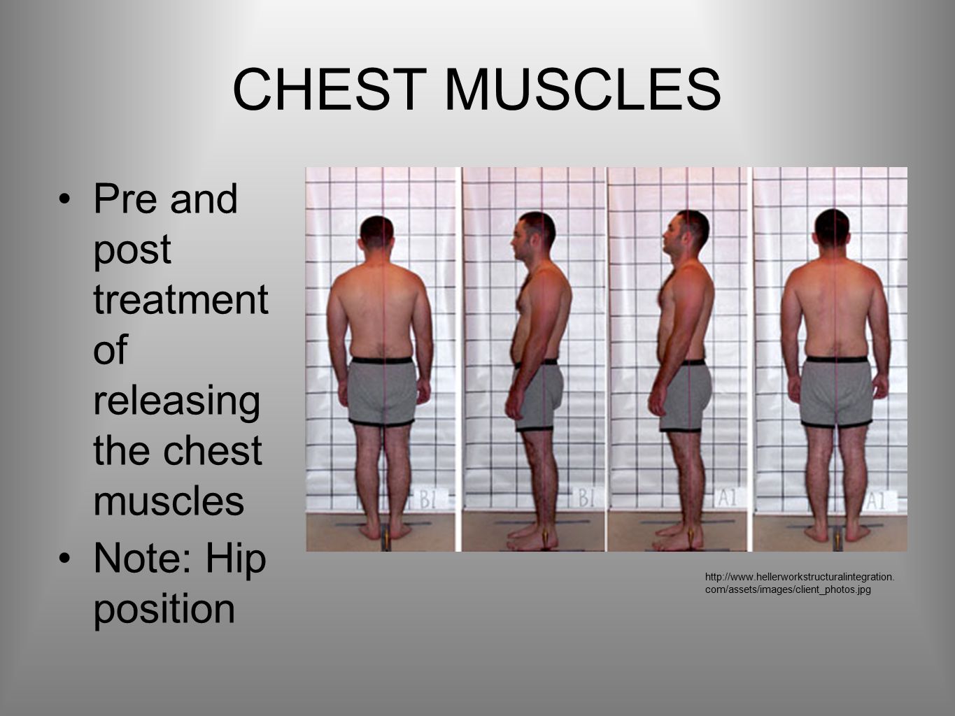 CHEST MUSCLES Pre and post treatment of releasing the chest muscles Note: Hip position