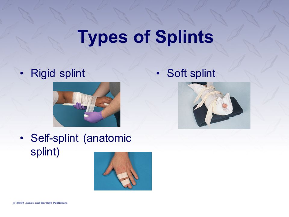 Chapter 16 Splinting Extremities. Splinting Reduces pain Prevents further  damage to muscles, nerves, and blood vessels Prevents closed fracture from  becoming. - ppt download